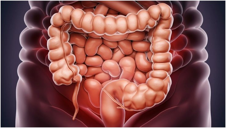 Tumore al colon sintomi