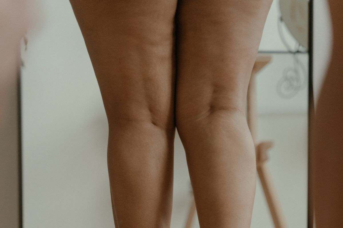 La corsa peggiora la cellulite