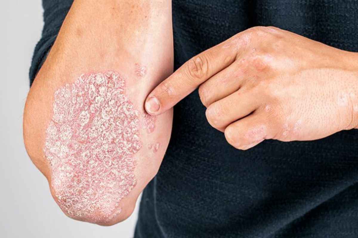 Psoriasi, cosa è e come combatterla: tutto quello che c’è da sapere