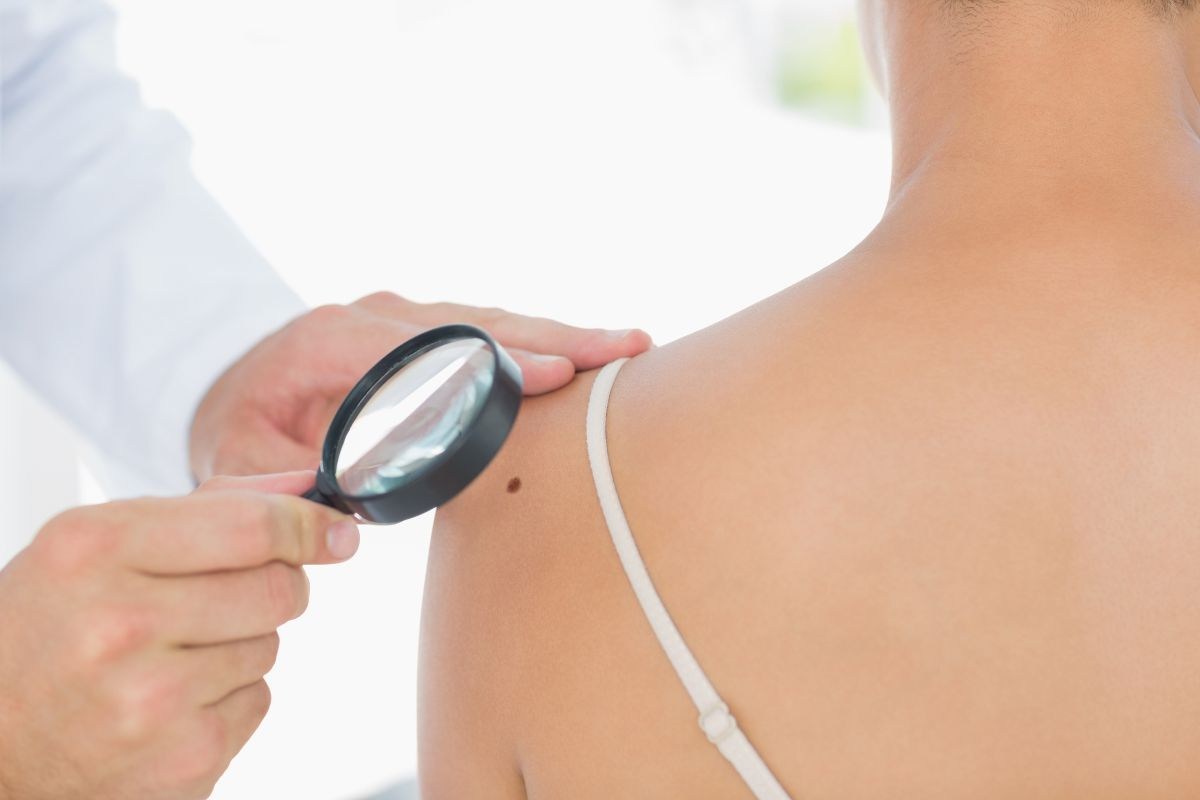 Melanoma: immunoterapia e batteri intestinali, la chiave per la cura?