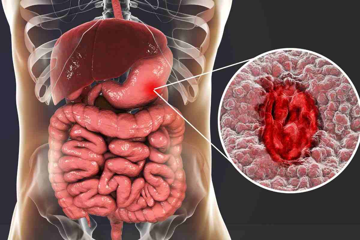 La colite ulcerosa è molto diffusa in Italia